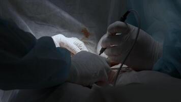 Close up of professional surgeons cauterizing an open wound during medical procedure. Action. Doctors in clean uniform using professional equipment. video