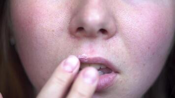 Young woman suffering from herpes on lips. Media. Close up of woman fingers applying ointment onto lips, treatment of herpes infection and virus. video