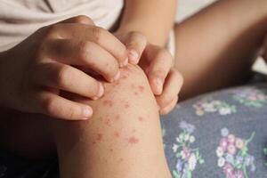 Close up view of child scratching his itching knee due to being infected with hand feet and mouth disease or HFMD originating from enterovirus or coxsackie virus, photo