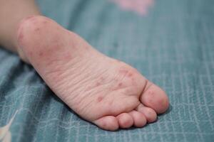 close up view of child's feet infected with hand feet and mouth disease or HFMD originating from enterovirus or coxsackie virus, zoom shot. photo