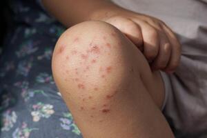 knee of a child infected with hand feet and mouth disease or HFMD originating from enterovirus or coxsackie virus, close up view zoom shot. photo