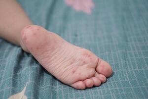 close up view of child's feet infected with hand feet and mouth disease or HFMD originating from enterovirus or coxsackie virus, zoom shot. photo