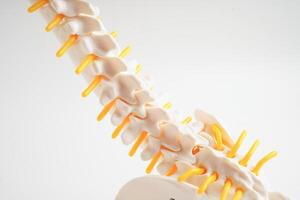 espinal nervio y hueso, lumbar espina desplazado herniado Dto fragmento, modelo para tratamiento médico en el ortopédico departamento. foto