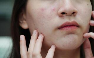 Acne pimple and scar on skin face, disorders of sebaceous glands, teenage girl skincare beauty problem. photo