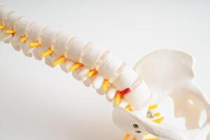 espinal nervio y hueso, lumbar espina desplazado herniado Dto fragmento, modelo para tratamiento médico en el ortopédico departamento. foto