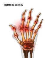 Rheumatoid arthritis image sore inflammation joints of bones the of hand. vector