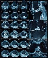 magnético resonancia tomografía mrt imágenes de rodilla foto