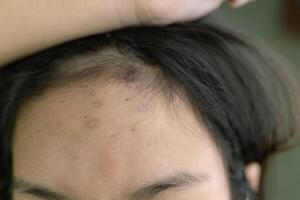 A woman with a black head has a few blemishes on her forehead photo