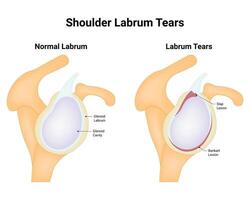 Shoulder Labrum Tears Science Design Vector Illustration Diagram