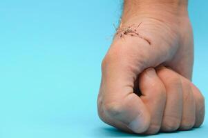 Suture wound on hand,Pain of accident concept photo