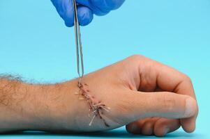 sutura herida en mano, dolor de accidente concepto foto