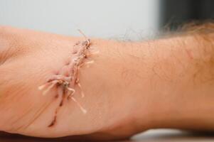 Suture wound on hand,Pain of accident concept photo