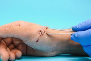 Suture wound on hand,Pain of accident concept photo