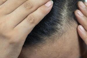 Close Up Young people have problems with hair loss, dryness, dullness, split ends and damage. photo