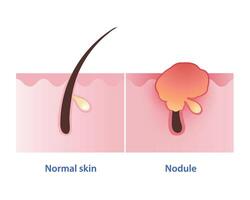 Nodule, type of inflammatory acne vector on white background. Normal skin and nodular acne is firm, painful lump to form under your skin and red bump is inflamed to appear on the skin surface.