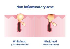 The difference between whitehead and blackhead acne vector illustration. Whitehead and blackhead are both types of non inflammatory acne, they are forms of comedones. The pore is closed or open.