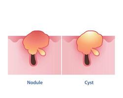 el diferencia Entre nódulo y quiste vector en blanco antecedentes. nodular es firme, doloroso, rojo bache en el superficie piel. cístico acné consistir de profundo, pus completado. el ambos son inflamatorio severo.