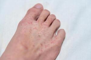 Allergic reaction, Red rash itychy on foot photo