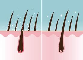 comparación de caspa en pelo y sano pelo en cuero cabelludo capa vector ilustración. pelo con blanco seco escamoso, escamoso cuero cabelludo y nutrido. pelo cuidado y problema concepto.