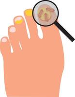 Onychomycosis. Feet with nail disease. Fungal nails infection. Doctors exam, treat nails psoriasis. vector