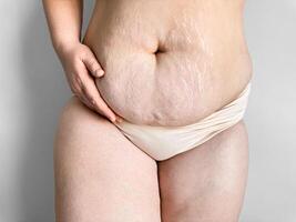 Postpartum womans midsection showing stretch marks, body positivity and real post pregnancy changes concept. photo