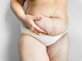 Postpartum womans midsection showing stretch marks, body positivity and real post pregnancy changes concept. photo