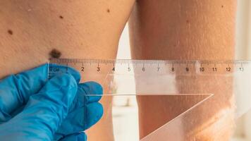 Unrecognizable Doctor in medical gloves examining length and width of benign moles on man skin. Dermatologist checking male birthmarks with ruler. Pigmentation. photo