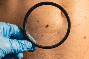 Unrecognizable Dermatologist examining patient's birthmark with magnifying glass in clinic. Mole dermoscopy, preventive of melanoma. Checking benign moles. Skin abnormalities care concept. photo