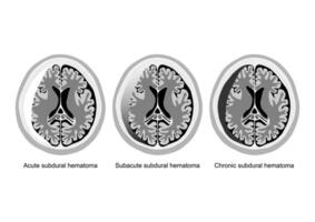 Stages of subdural hematoma brain injury illustrated. vector