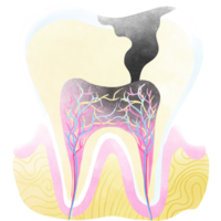 Zahn zerfallen ist verursacht durch nicht Pflege zum Ihre Zähne. png