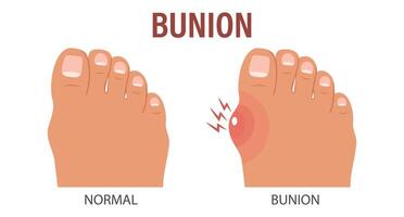 Foot with painful bunion. Healthy and sick feet. Healthcare and medicine. Illustration. vector