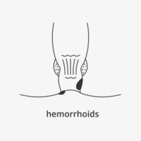 interno y externo hemorroides línea icono. infografía anal estructura. ilustración vector