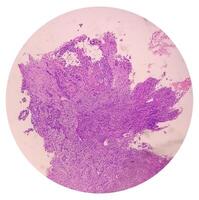 Photomicrograph of histological slide showing Lobular capillary hemangioma on finger. photo