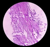 Photomicrograph of histological slide showing Lobular capillary hemangioma on finger. photo