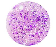 Photomicrograph Bone marrow study, Megakaryocytic Hyperplasia photo