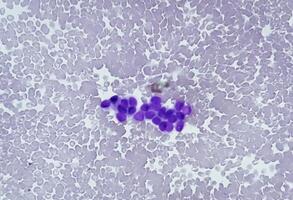 Ascetic fluid cytology, Malignant cells, Metastatic adenocarcinoma photo