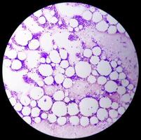 Human meningioma. Meningioma cells are relatively uniform, with a tendency to encircle one another, forming whorls and psammoma bodies, concentric laminated eosinophilic bodies that tend to calcify photo