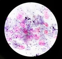 Paps smear analysis, Superficial squamous cell, metaplastic squamous cell, koilocytes cell. HPV related change photo