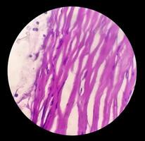 Photomicrograph of histological slide showing Lobular capillary hemangioma on finger. photo