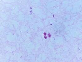 Ascetic fluid cytology, Malignant cells, Metastatic adenocarcinoma photo