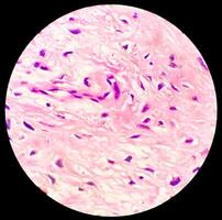 Leg tissue biopsy, Photomicrographic image showing Fibromyxoma. Superficial Acral Fibromyxoma, rare slow growing myxoid tumor photo