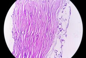 microfotografía de histológico diapositiva demostración lobular capilar hemangioma en dedo. foto