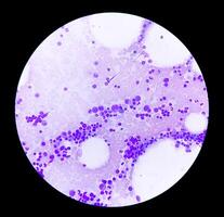 Photomicrograph Bone marrow study, Megakaryocytic Hyperplasia photo