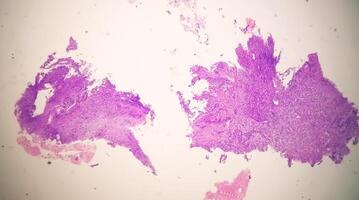 Histology, Peritoneal inclusion cyst. Paraovarian cysts, hydrosalpinx and low-grade cystic mesothelioma are usually considered in the differential diagnosis of PICs. photo