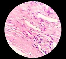 Photomicrograph of histological slide showing Lobular capillary hemangioma on finger. photo