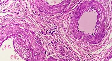 Histology, Peritoneal inclusion cyst. Paraovarian cysts, hydrosalpinx and low-grade cystic mesothelioma are usually considered in the differential diagnosis of PICs. photo