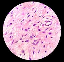 Leg tissue biopsy, Photomicrographic image showing Fibromyxoma. Superficial Acral Fibromyxoma, rare slow growing myxoid tumor photo