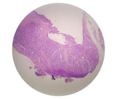 microfotografía de histológico diapositiva demostración lobular capilar hemangioma en dedo. foto