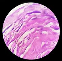 Photomicrograph of histological slide showing Lobular capillary hemangioma on finger. photo