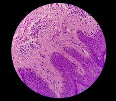 histológico fotomicrografía. prurigo nodular o pn es un crónico trastorno de el piel. foto